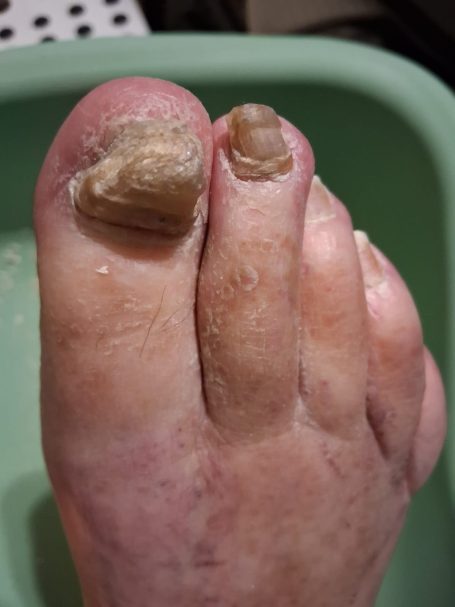 Fungal Nail