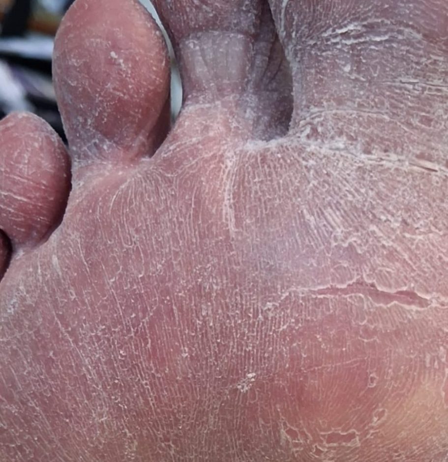 Athetes Foot